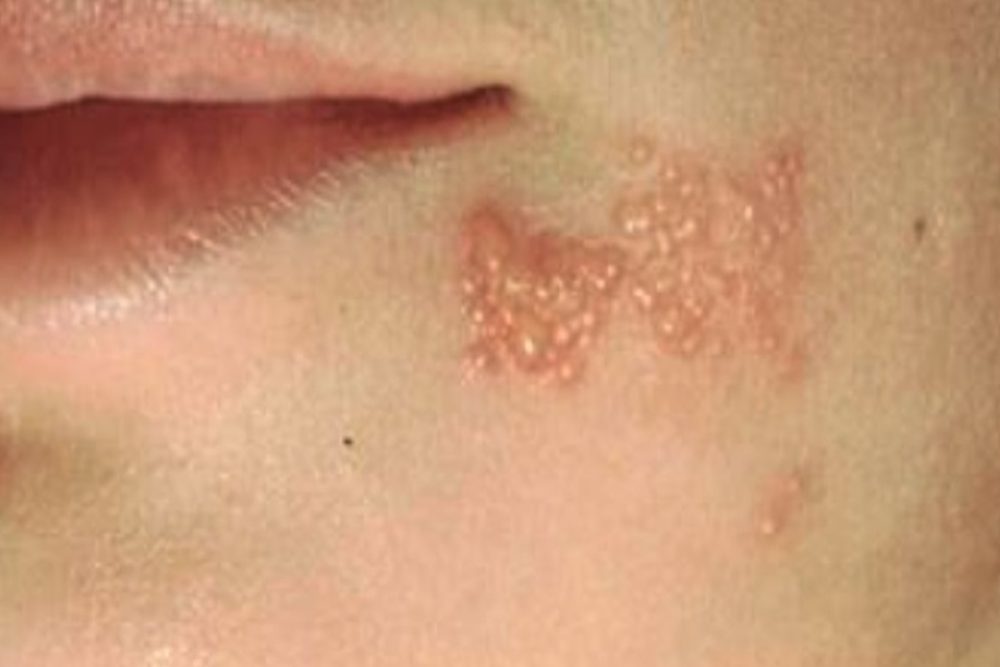 Waspada, Virus Cacar Air Bisa Bangkit Lagi Saat Imunitas Turun